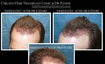 Hair restoration procedure before and after pictures