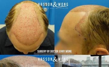 Hair restoration procedure before and after result images