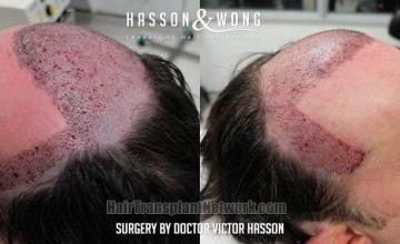 Hair replacement surgery before and after images