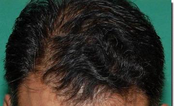 Hair restoration procedure results