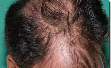 Hair restoration procedure results