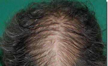 Hair restoration procedure results