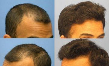 Closeup of pictures showing patients restored left and right hairlines