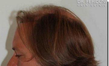 Hair restoration procedure results