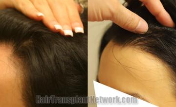 Before and after hair transplantation result photographs