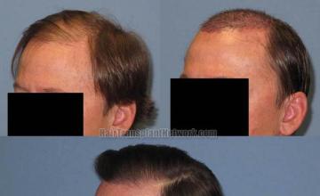 Hair transplantation surgery before and after pictures