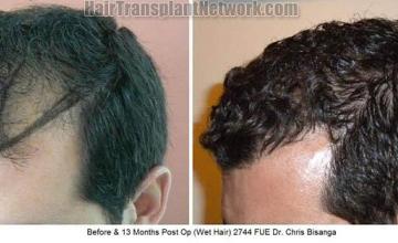 Hair transplantation surgery before and after pictures