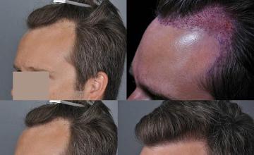 Hair transplantation surgery before and after photos