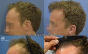 Hair transplantation surgery before and after pictures