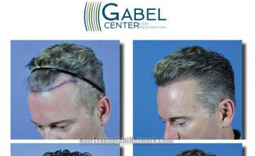 Hair transplantation surgery before and after photos