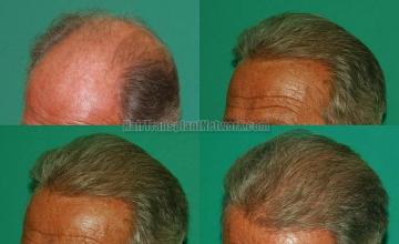 Hair restoration procedure before and after pictures