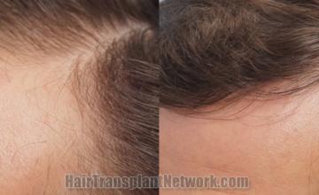 Before and after hair transplantation result photographs