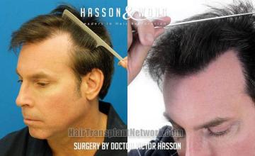 Surgical hair transplantation result photographs