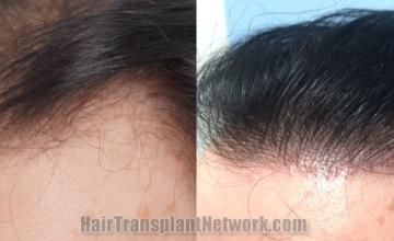 Before and after hair transplantation result photographs