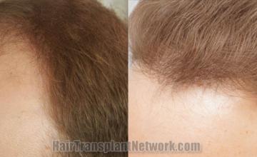 Before and after hair transplantation result photographs