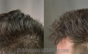 Before and after hair transplantation result photographs