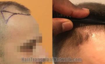 Hair restoration procedure before and after pictures