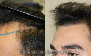 Before and after hair transplantation result photographs