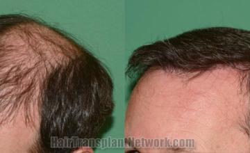 Before and after hair transplantation result photographs