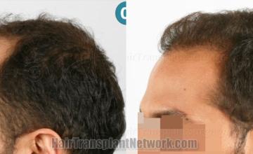 Before and after hair transplantation result photographs