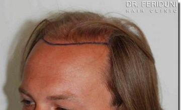 Hair restoration procedure results