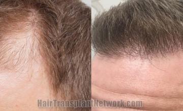 Hair restoration procedure before and after pictures