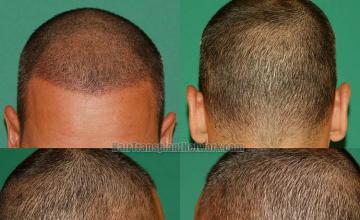 Surgical hair transplantation result photographs