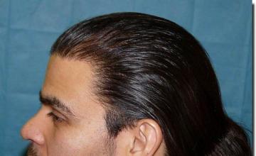 Hair restoration procedure results