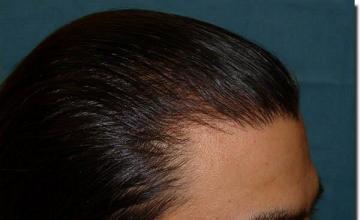 Hair restoration procedure results