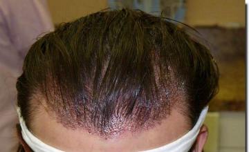 Hair restoration procedure results