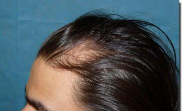 Hair restoration procedure results