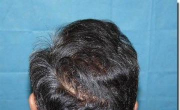 Hair restoration procedure results