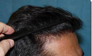 Hair restoration procedure results