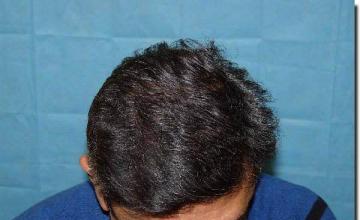 Hair restoration procedure results