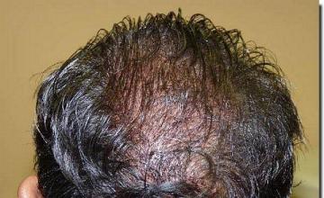 Hair restoration procedure results