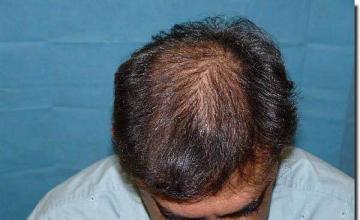 Hair restoration procedure results