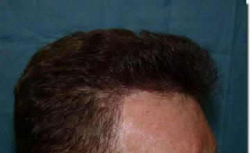 Hair restoration procedure results