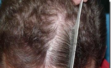 Hair restoration procedure results