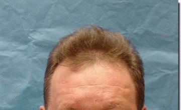 Hair restoration procedure results