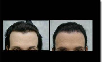 Hair restoration procedure results