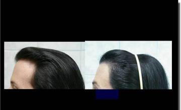 Hair restoration procedure results