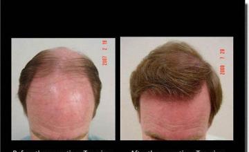 Hair restoration procedure results