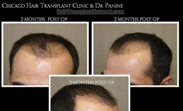 Hair restoration surgery before and after photos