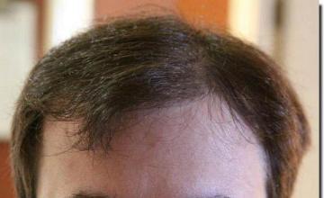 Hair restoration procedure results