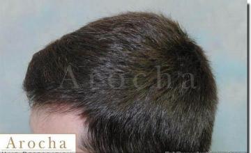 Hair restoration procedure results