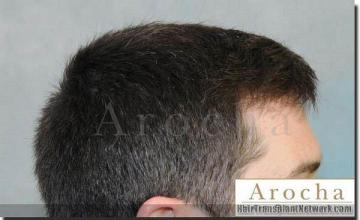 Hair restoration procedure results