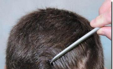 Hair transplantation FAQs