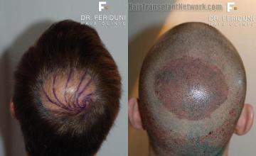 Hair transplantation surgery before and after pictures