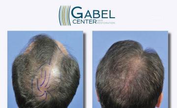 Hair restoration procedure before and after pictures