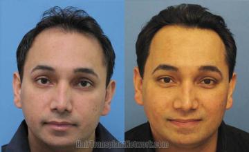 Before and after hair transplant photos